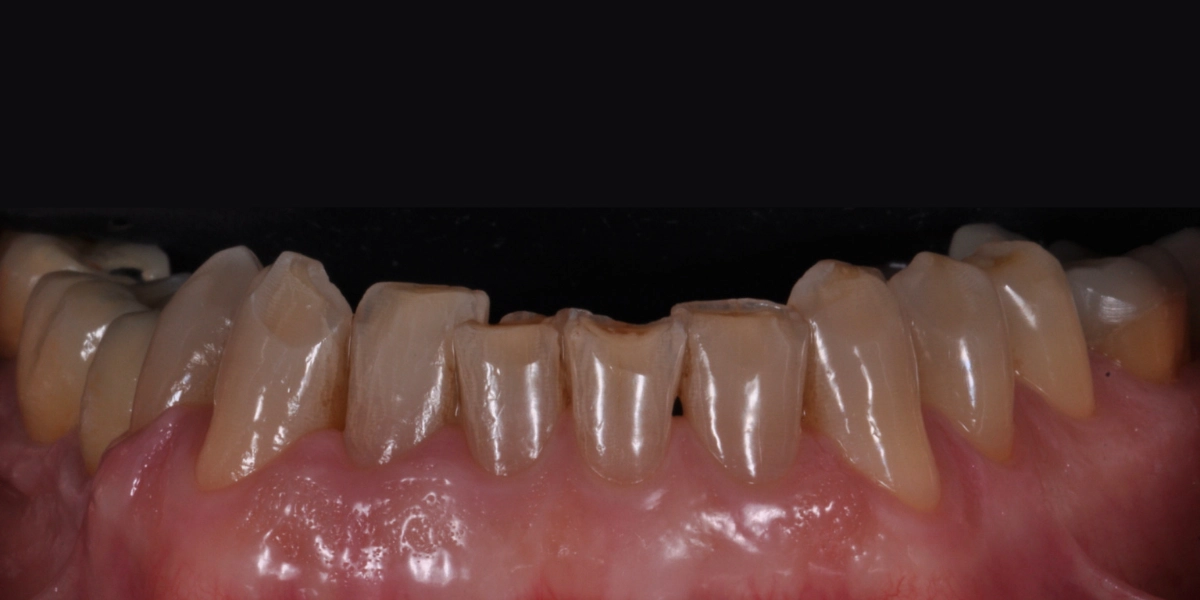 Denti usurati 2 - prima