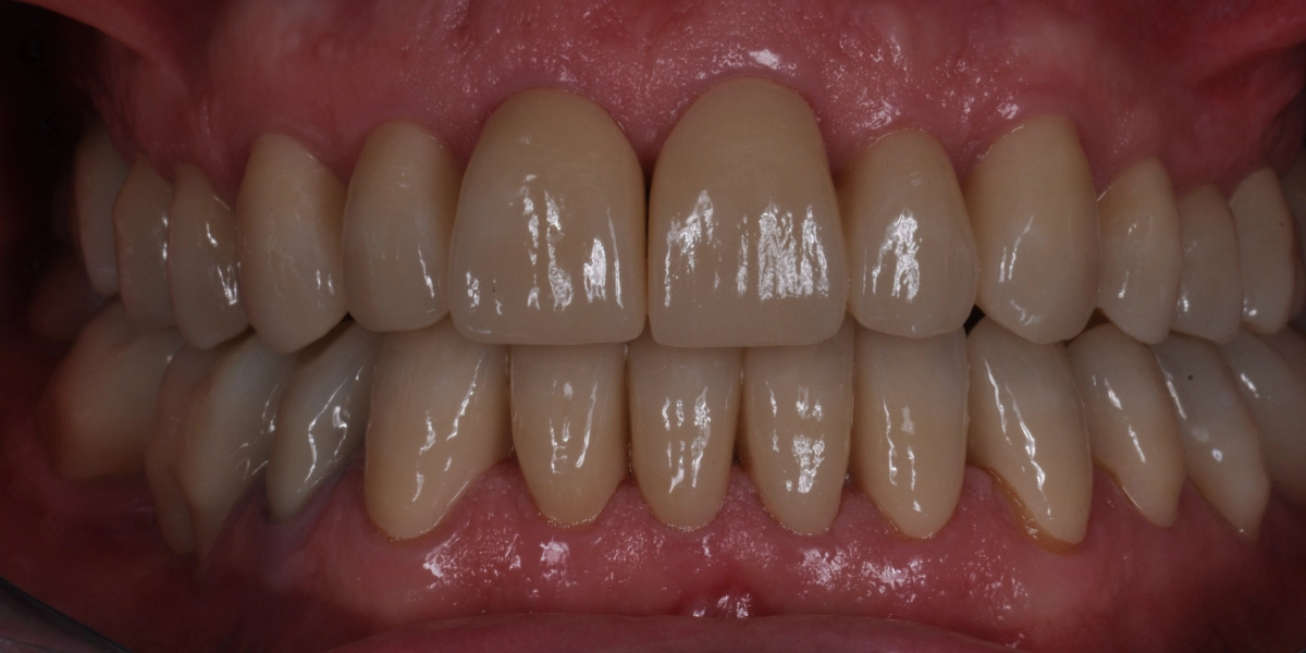 Denti usurati 3 - dopo