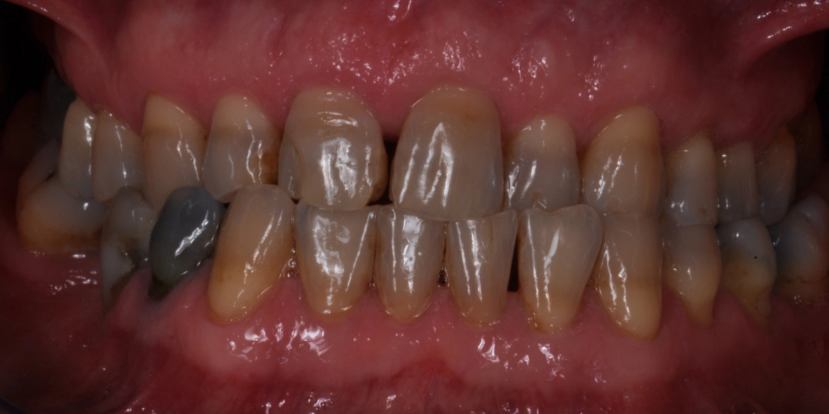 Denti usurati 3 - prima