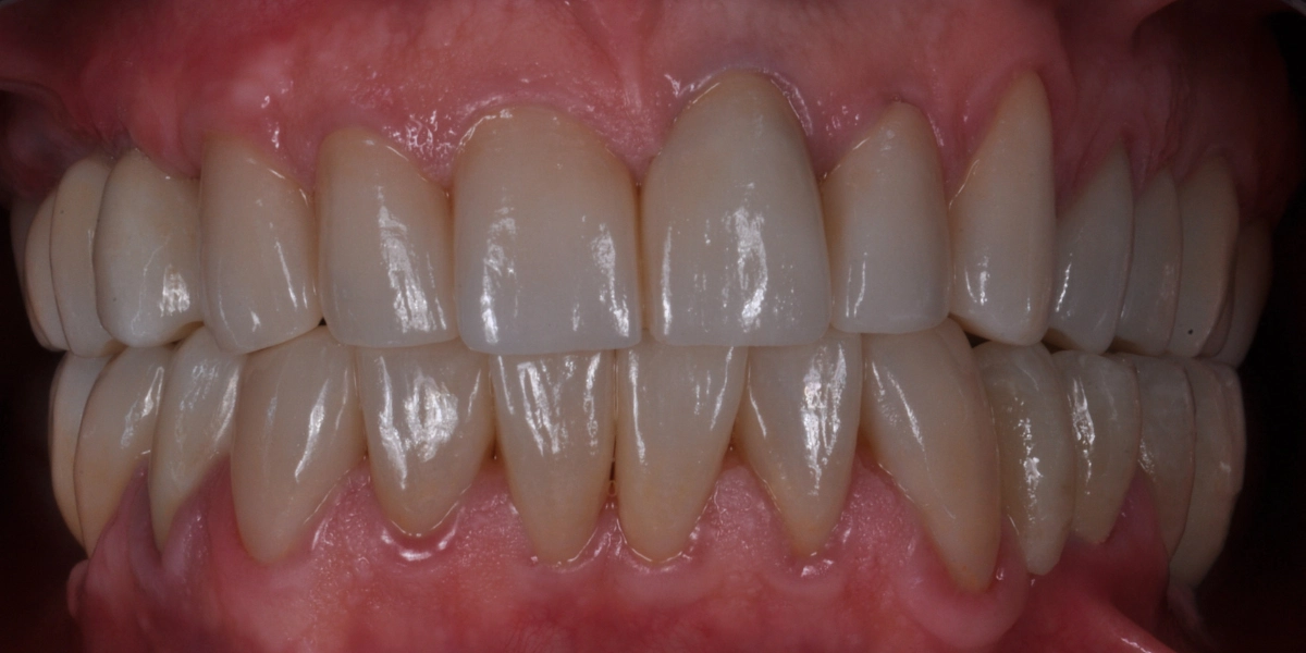 Denti usurati 4 - dopo