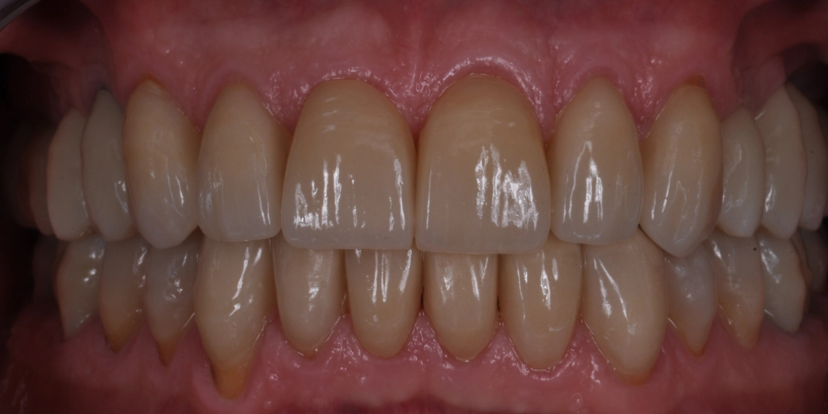 Denti usurati 5 - dopo