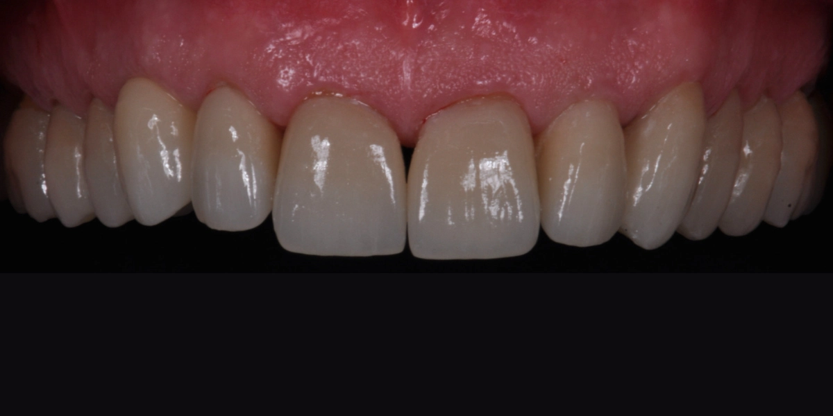 Denti usurati dopo