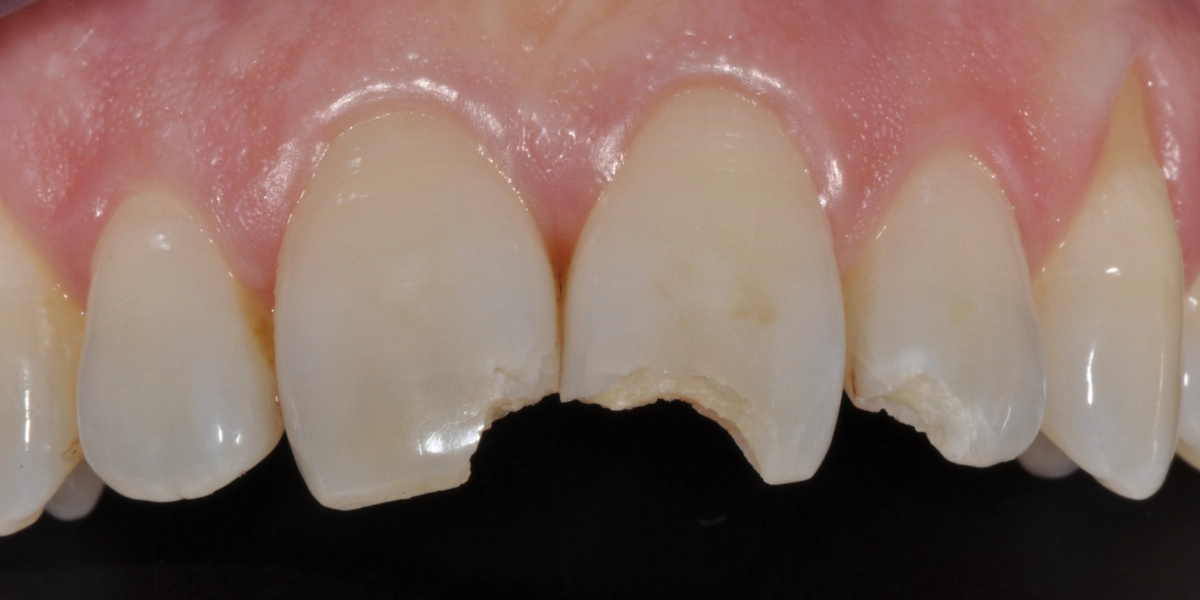 Faccette dentali 2 - prima