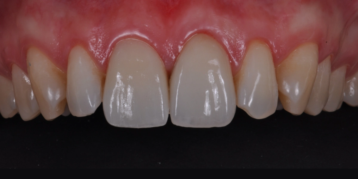 Faccette dentali 6 - dopo