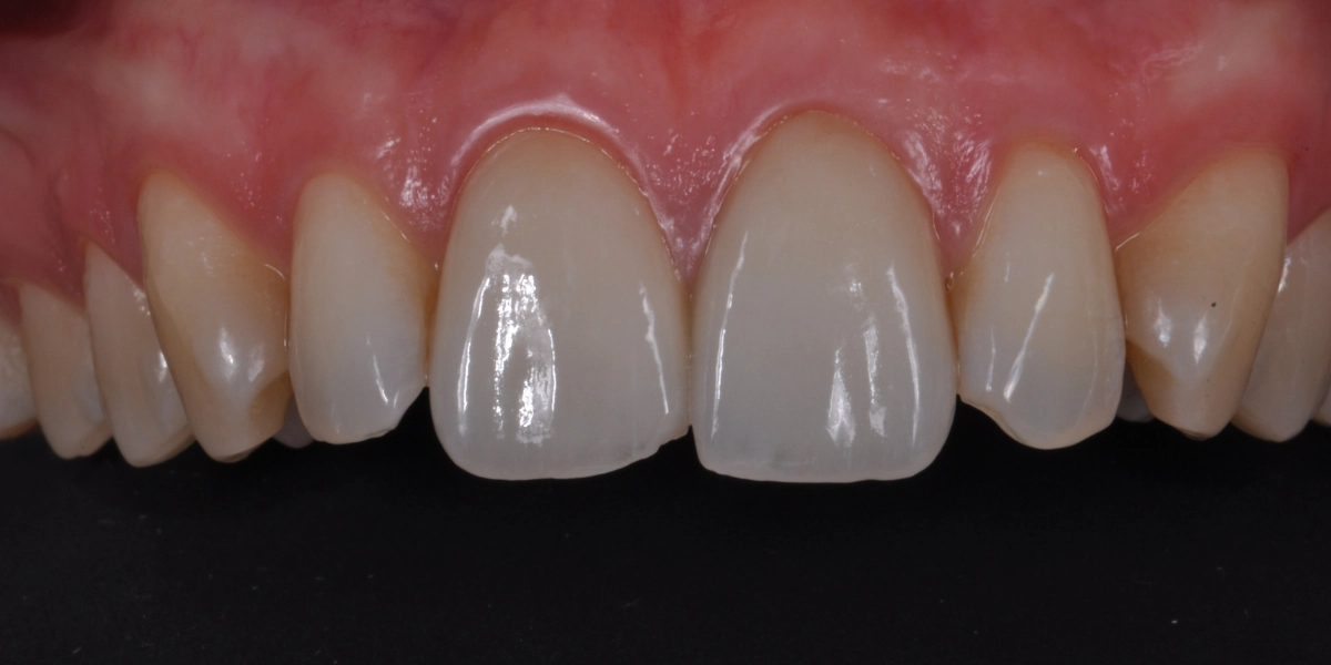 Faccette dentali 6 - prima